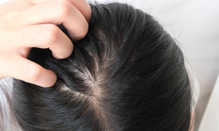 臉皮要呵護，頭皮脂漏性問題也需小心照顧！