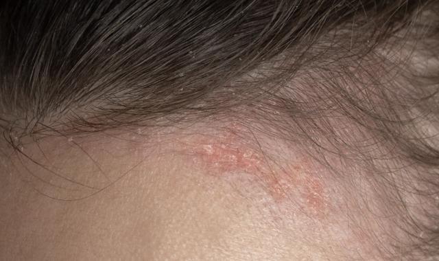 頭皮也有酒糟性皮膚炎?!教您如何保養酒糟肌