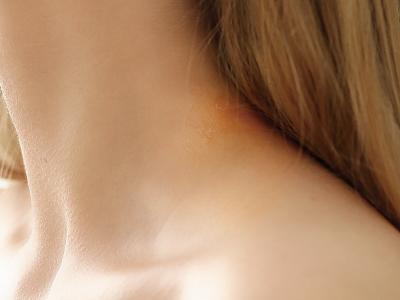 濕疹與乾癬如何分辨？5分鐘一次搞懂差異