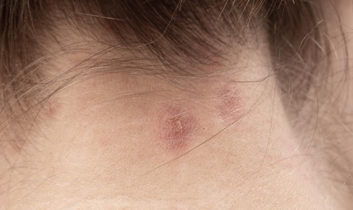 隱形炸彈？！頭皮皮脂腺囊腫知多少？