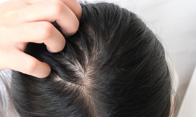 臉皮要呵護,頭皮脂漏性問題也需小心照顧!