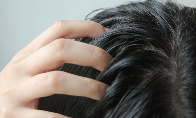 異位性皮膚炎:頭皮健康的重要關鍵