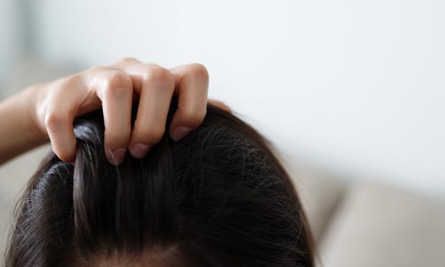 頭皮出現紅斑性狼瘡症狀?別怕,這樣處理最安心