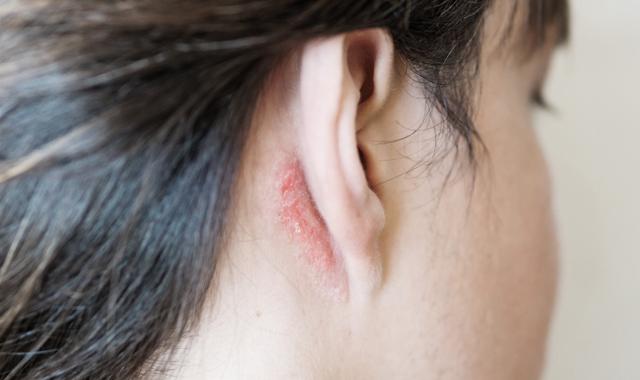 別讓頭皮牛皮癬影響你的生活!改善關鍵就在日常保養